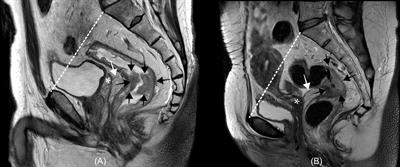 Clinical implication and management of rectal cancer with clinically suspicious lateral pelvic lymph node metastasis: A radiation oncologist’s perspective